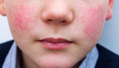 'Infection outbreak' of parvovirus in Hamilton County, health officials say