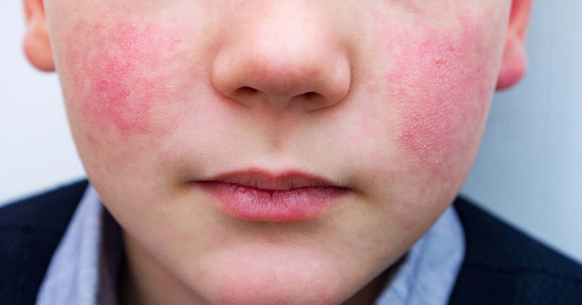 'Infection outbreak' of parvovirus in Hamilton County, health officials say