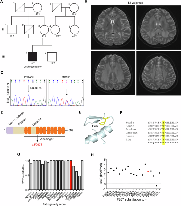 Pathogenic ZNF319 variant disrupts nuclear localization and transcriptional regulation to cause a novel form of autosomal recessive leukodystrophy