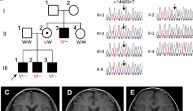 A Japanese familial spastic paraplegia associated with a missense UBQLN2 variant