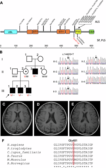 A Japanese familial spastic paraplegia associated with a missense UBQLN2 variant