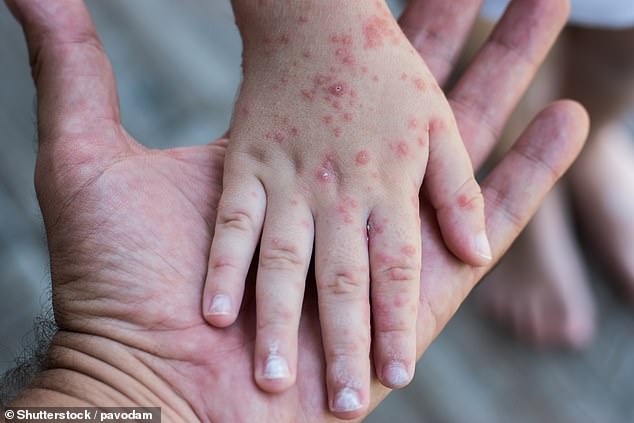 Manhattan is gearing up for an outbreak of another highly contagious virus, as numbers of hand, foot and mouth disease (HFMD) cases spike across the US