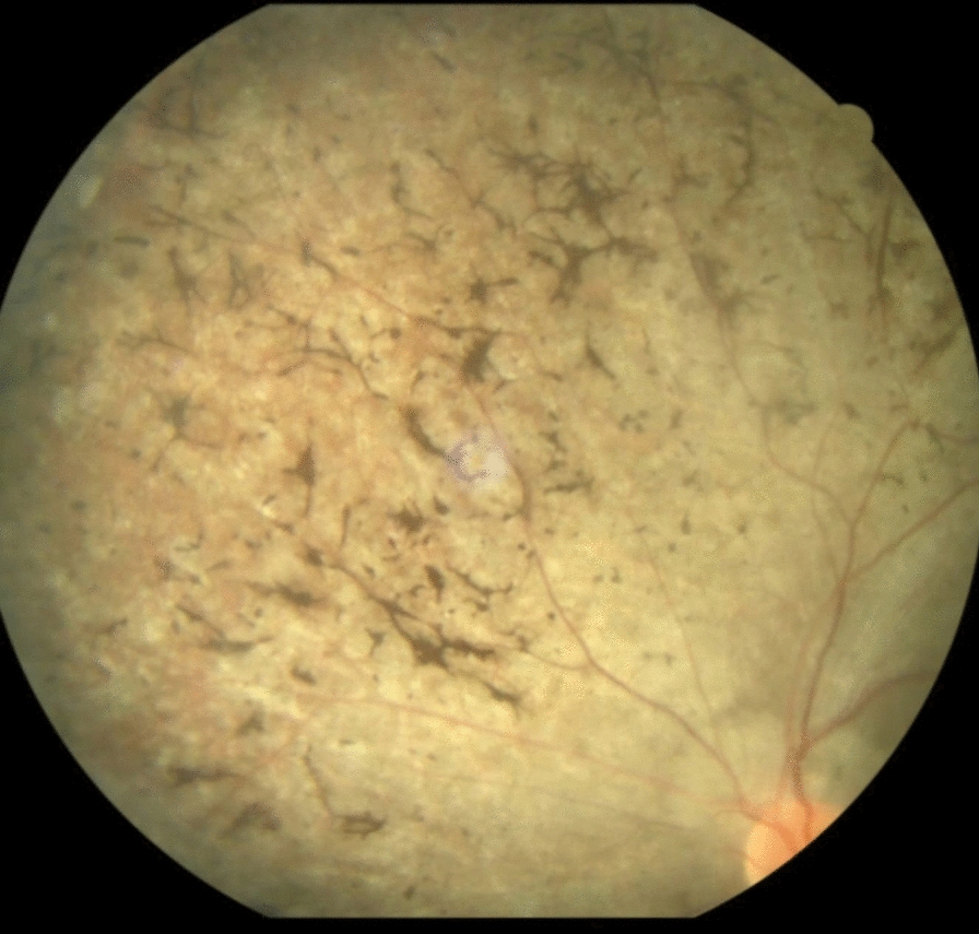 Incidental diagnosis of Bardet–Biedl syndrome in a case of abdominal tuberculosis: a case report | Journal of Medical Case Reports