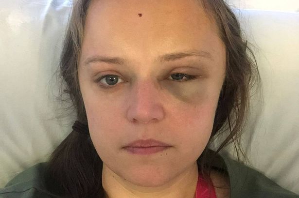 Kim WIlson in hospital following her tonic-clonic seizure