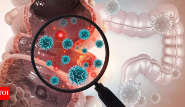 Bowel Cancer Symptoms: 5 warning signs of bowel cancer and how to reduce the risk, according to a gut expert |
