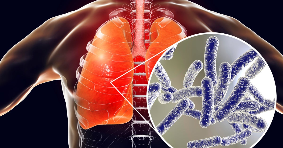 5th Legionnaires' disease death in NYC outbreak, health officials say