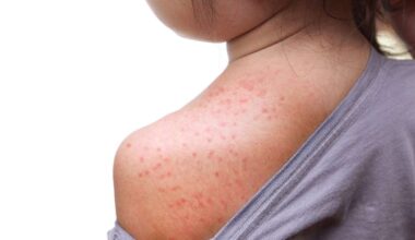 2 school-aged children in Washington County test positive for measles