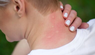 Why Do Mosquitoes Bite Some People More Than Others?