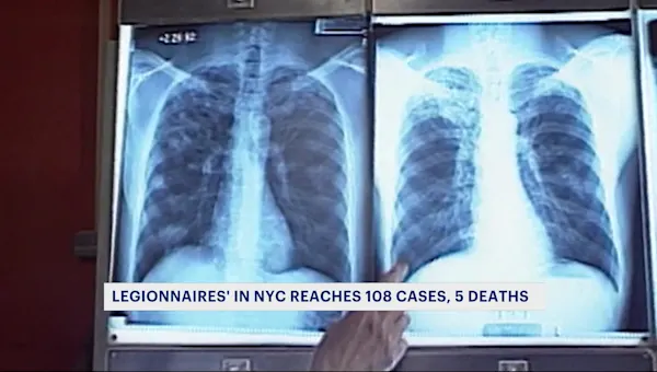 5 deaths, 108 confirmed cases of Legionnaire’s disease in New York City