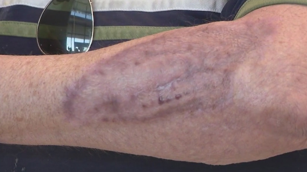 (Related) Burn victim warns against Arizona's heat