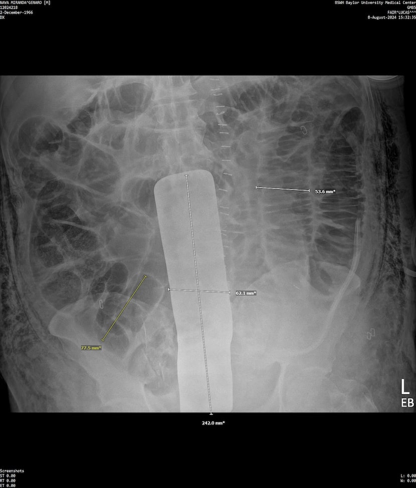 Genaro Nava and his attorney allege that a surgical team at Baylor University Medical Center...