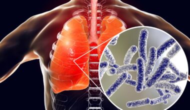 What is Legionnaires’ disease? How you get it, symptoms, treatment – NBC Connecticut