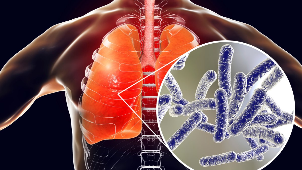 What is Legionnaires’ disease? How you get it, symptoms, treatment – NBC Connecticut
