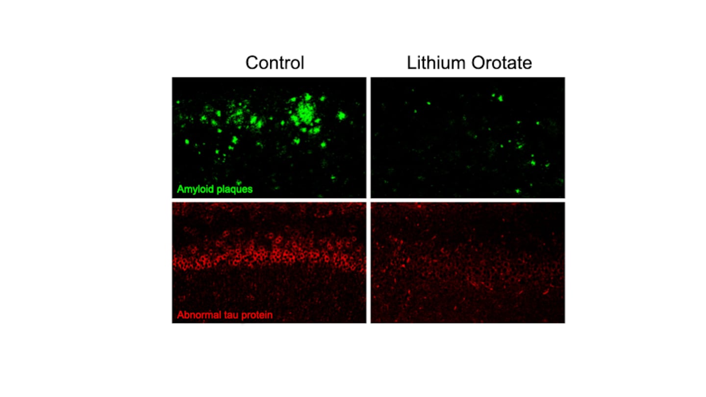These images show that treatment of the Alzheimer mice with a very low dose of lithium orotate almost completely abolishes both the plaques and the tangle-like structures.
