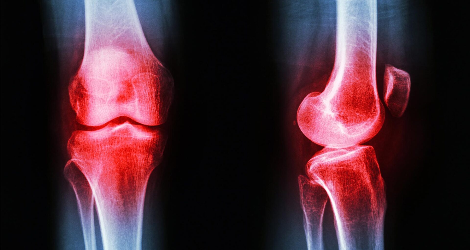Osteoarthritis Knee Inflammation