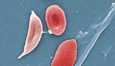 Sickle cell research points to need for DNA testing