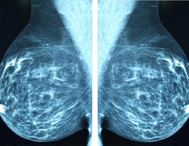 Artificial intelligence set to transform mental health care for breast cancer patients