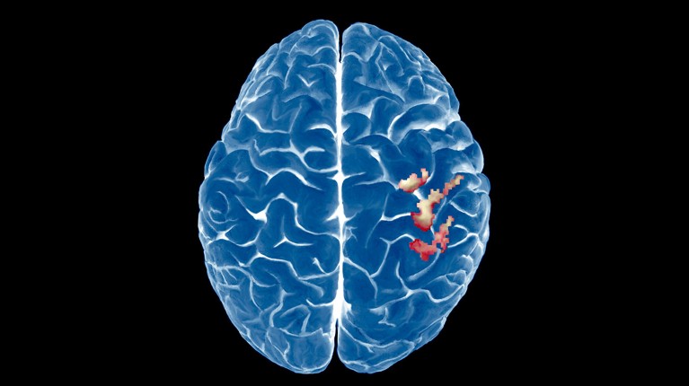 A 3-D fMRI brain scan with a red/brown area highlighting left hand control brain activity in the right cerebral hemisphere.