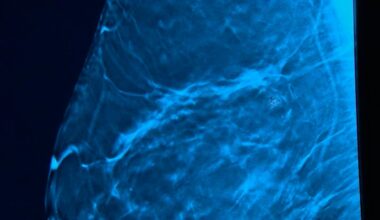 Graves Gilbert Clinic discusses advancements in breast cancer research for Breast Cancer Research Day