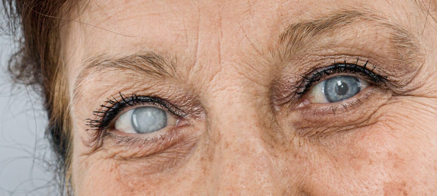 The Centre for Eye Research Australia is studying the genetic background of different cataracts. Image: oz/stock.adobe.com.