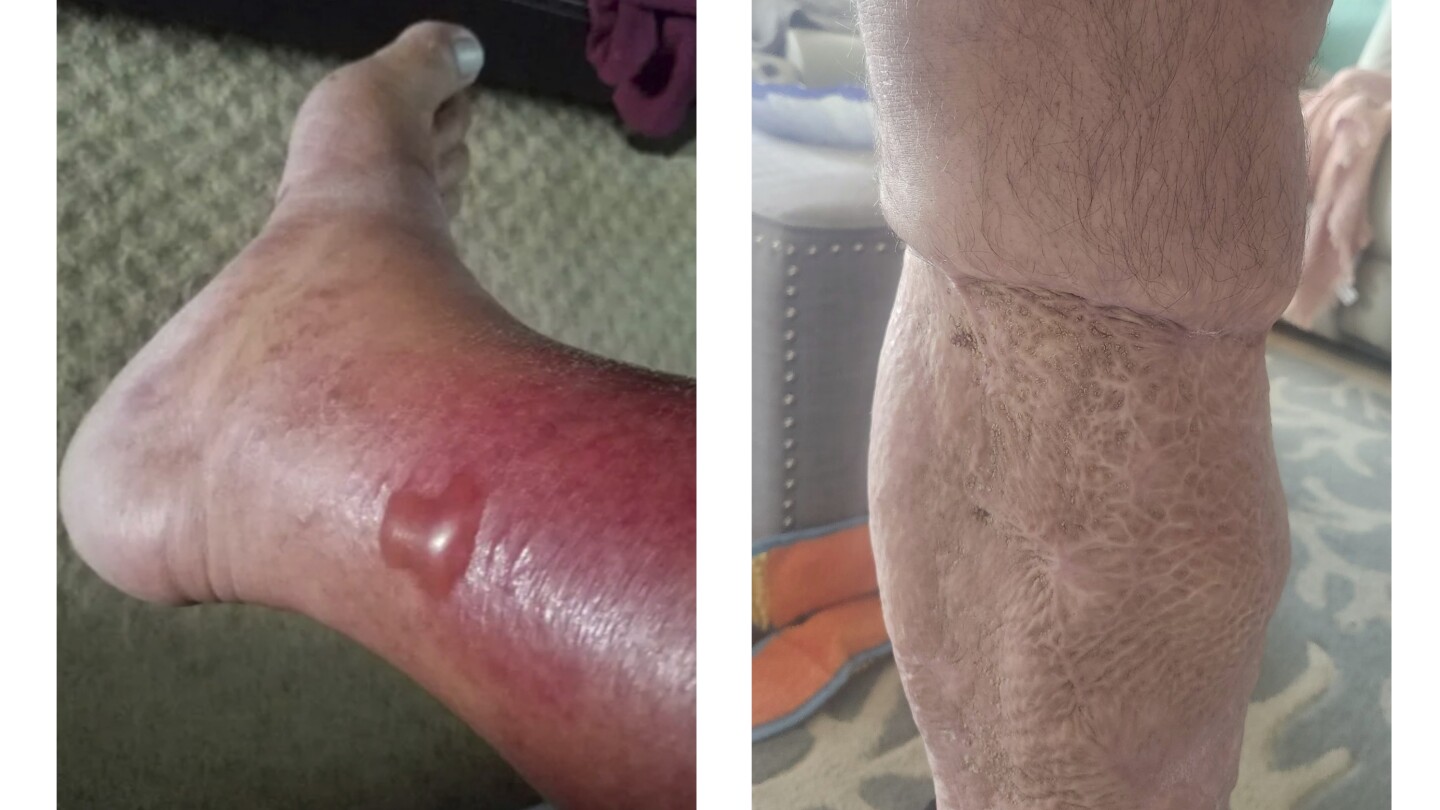 Flesh-eating bacteria infections: States alert beachgoers to Vibrio vulnificus threat