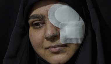 Photos of survivors of Israel's pager attack on Hezbollah last year