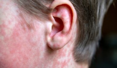 San Diego County confirms first measles case of 2025