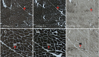 MYH2-associated myopathy caused by novel compound heterozygous mutations: a case report and literature review