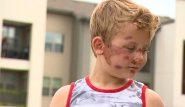 Mother, 8-year-old son recall hit-and-run that left him with severe road rash