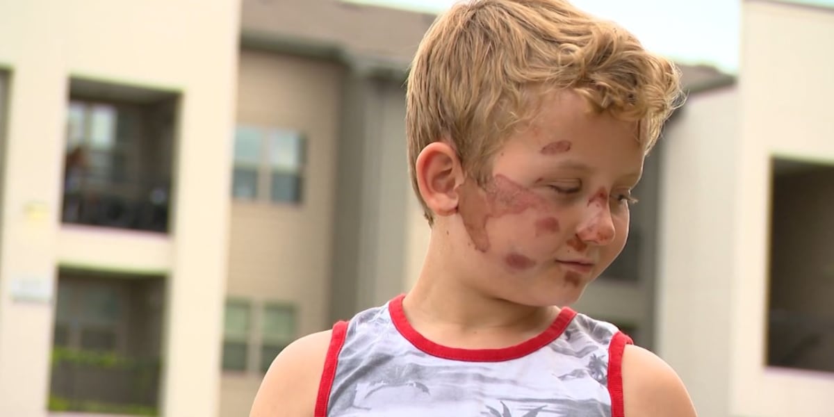 Mother, 8-year-old son recall hit-and-run that left him with severe road rash
