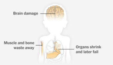 For Gaza's Children, Acute Malnutrition Could Cause a Lifetime of Health Challenges