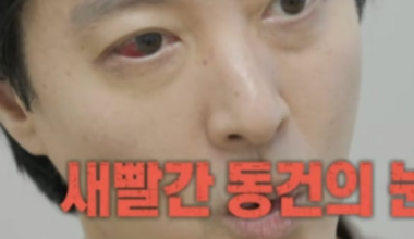 Lee Dong-gun Reveals Rare Genetic Disease Affecting 1% of South Koreans - 조선일보