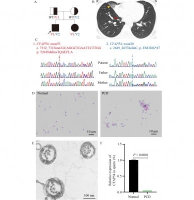Lack of CFAP54 causes primary ciliary dyskinesia in a mouse model and human patients