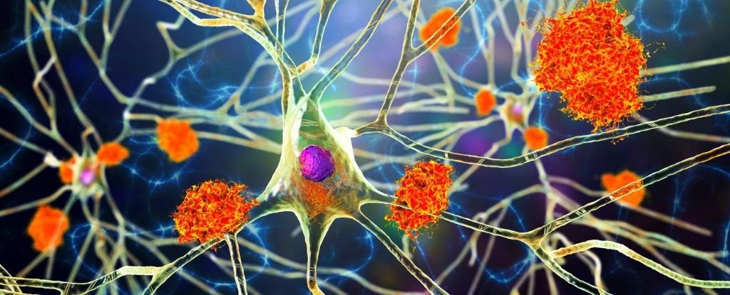 Clinical Trial To Transform Alzheimer's Diagnosis Launched in UK : ScienceAlert