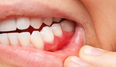 This Popular Diet Seems to Reduce Gum Disease, Scientists Say : ScienceAlert