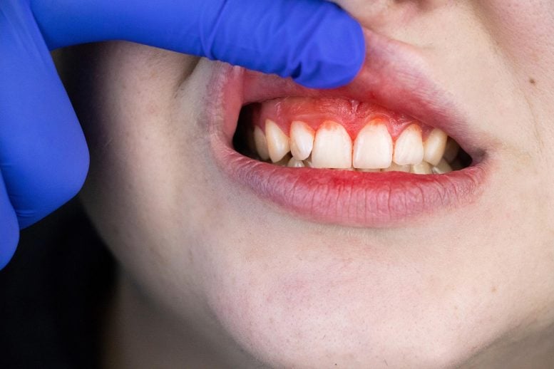 Bleeding Gums Gum Disease