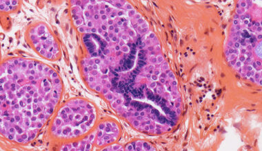 Breast Cancer Often Returns – But We May Have a New Way to Stop It : ScienceAlert