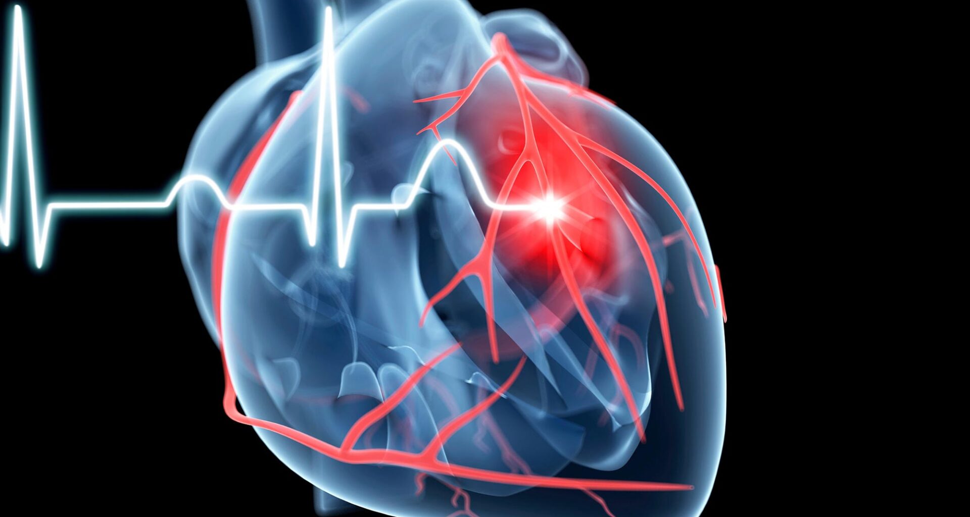Cardiology Heart Attack Illustration