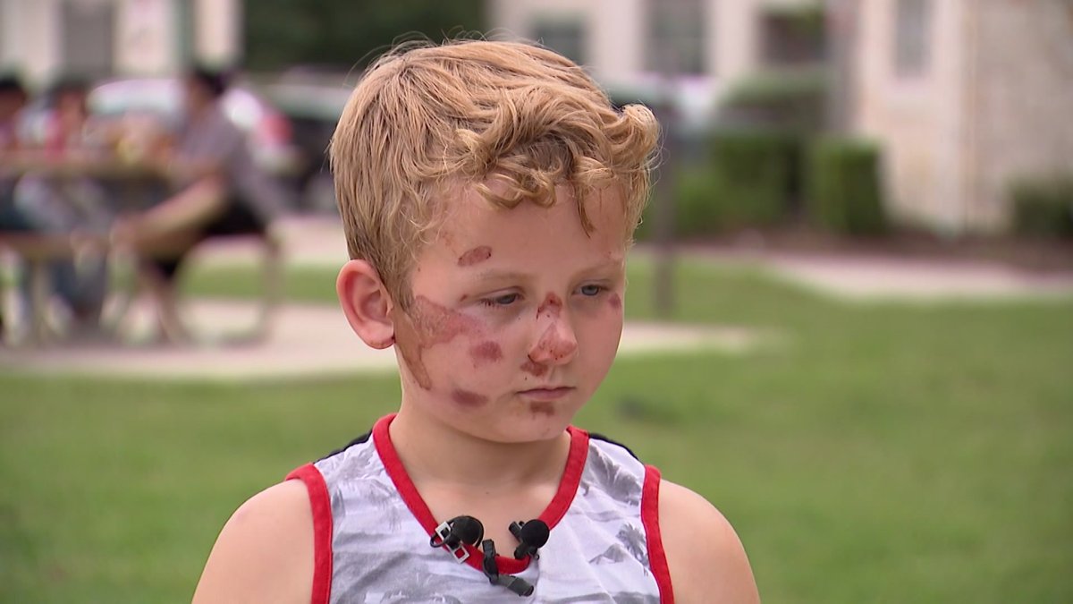 Boy injured in hit-and-run begins recovery – NBC 5 Dallas-Fort Worth