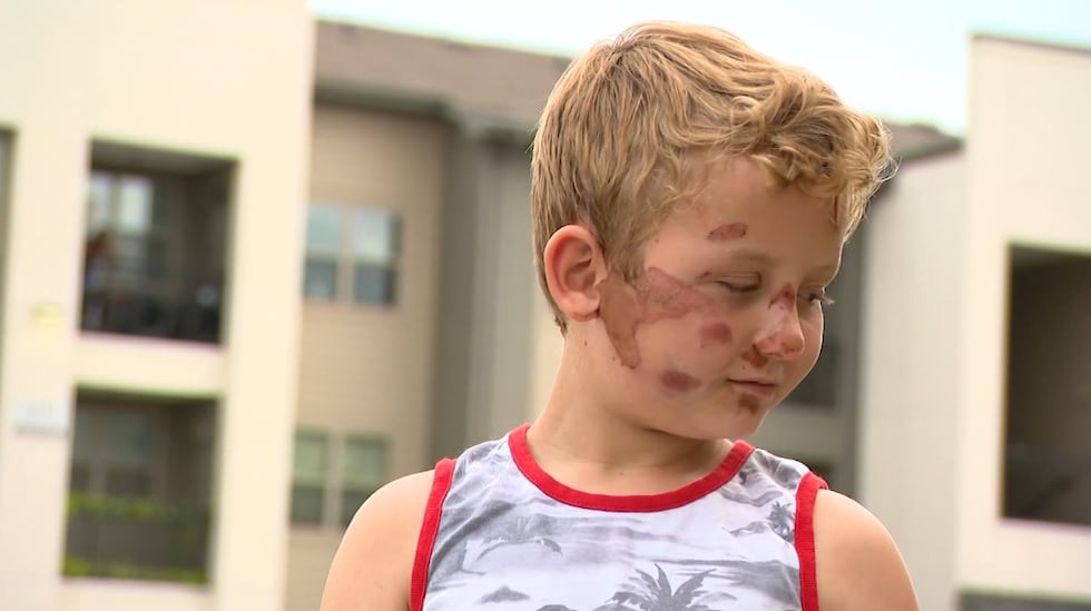 Liam Park, 8, suffered severe road rash across his face and on his arms when he was hit by an...