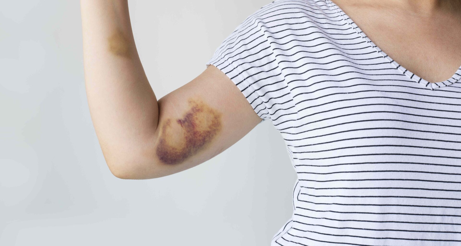 What To Know About Hemophilia, a Rare Blood Disorder