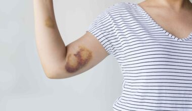 What To Know About Hemophilia, a Rare Blood Disorder