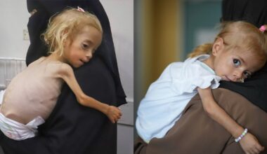 Malnourished Gaza girl with rare genetic disease recovers in Italian hospital