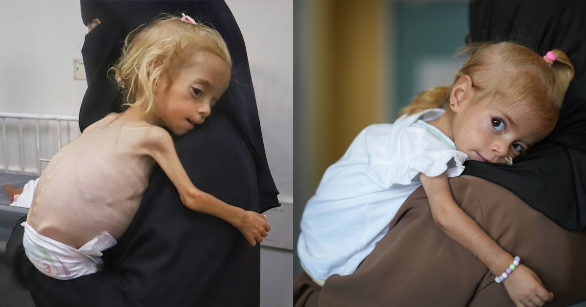 Malnourished Gaza girl with rare genetic disease recovers in Italian hospital