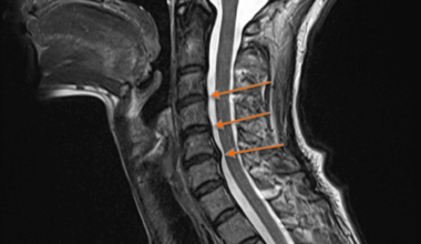 Huntington's Disease: A Case Report of a Patient With a Positive Family History