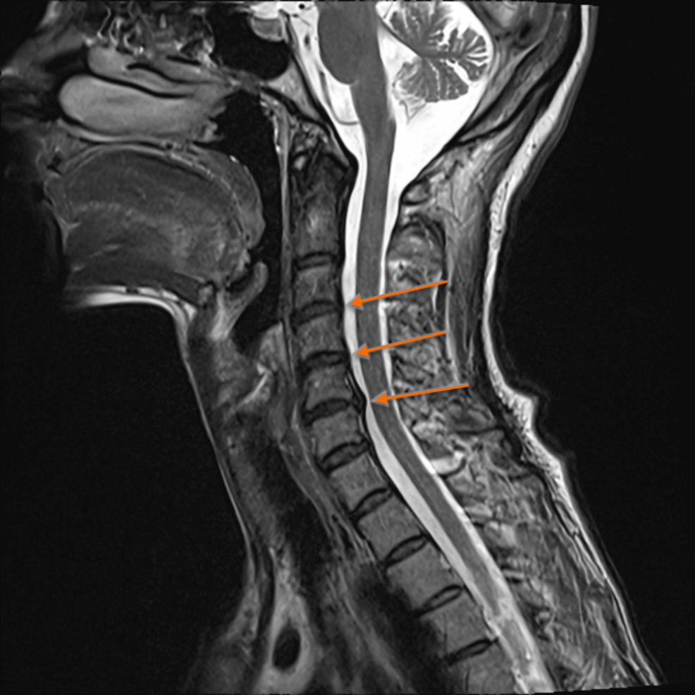 Huntington's Disease: A Case Report of a Patient With a Positive Family History