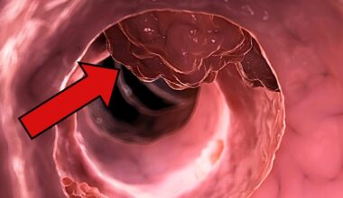 A Common Medicine May Stop Colorectal Cancer From Returning : ScienceAlert