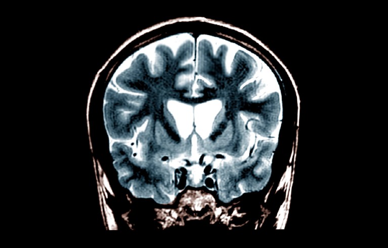 FLAIR MRI scan of the brain of a 21-old patient with Huntington's disease, showing atrophy of the cortex and caudate nuclei.