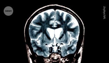 Huntington’s disease treated for first time using gene therapy