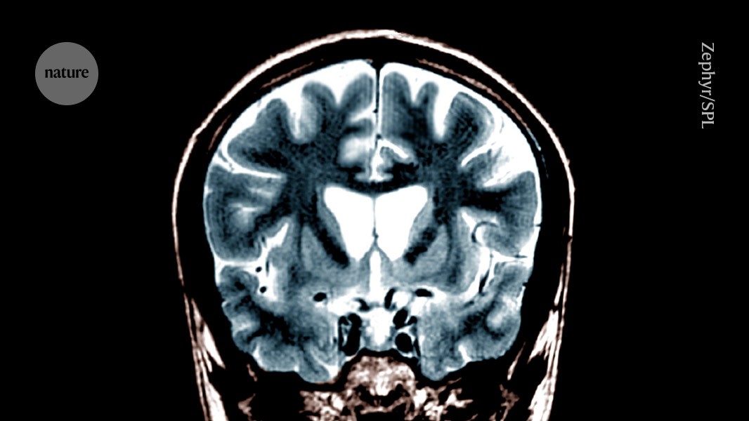 Huntington’s disease treated for first time using gene therapy